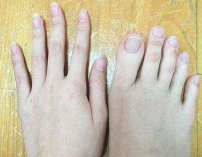 女子做足疗,脱鞋后技师惊呼从业十年首见